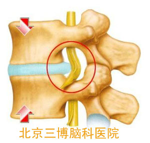 椎間盤(pán)突出