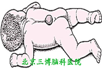 脊柱裂