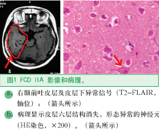 圖1 FCD IIA 影像和病理。