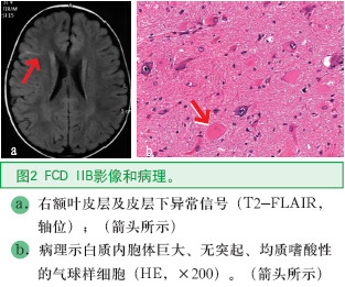 圖2 FCD IIB影像和病理。