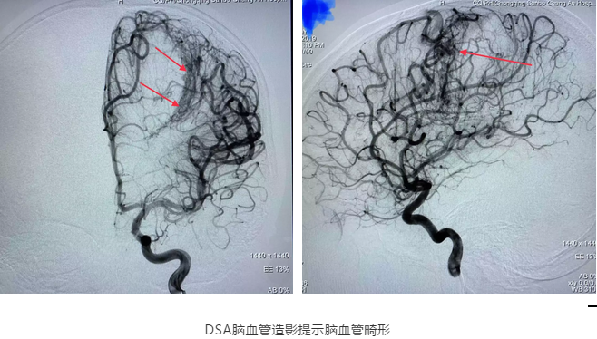 腦血管造影（DSA）證實為腦血管畸形