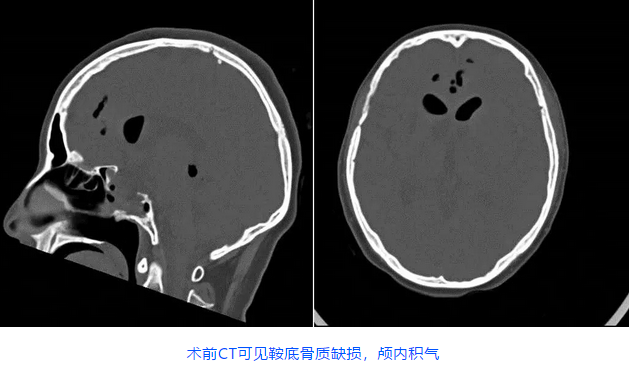 術(shù)前CT可見鞍底骨質(zhì)缺損，顱內(nèi)積氣