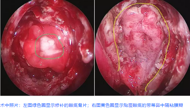 術(shù)中照片：左圖綠色圈顯示修補(bǔ)的鞍底骨片;右圖黃色圈顯示貼覆鞍底的帶蒂鼻中隔粘膜瓣