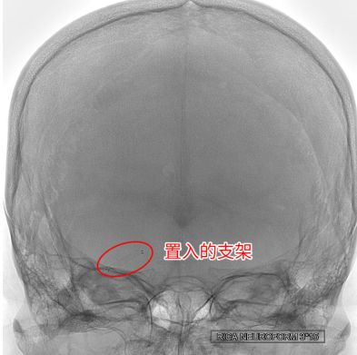 2個(gè)月內(nèi)腦梗2次 腦血管里“穿針引線”妙手“疏堵”