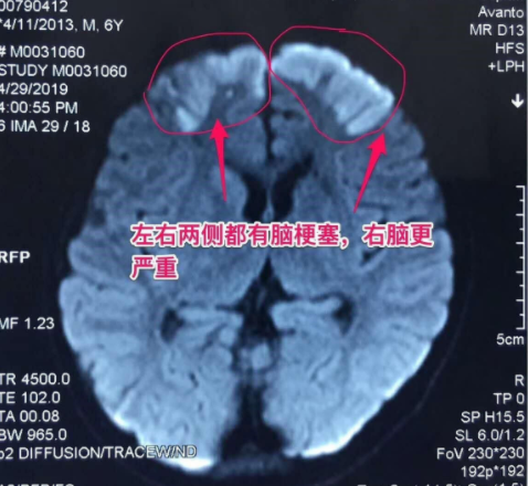 中老年多發(fā)腦梗，6歲兒童竟中招！說話不清、肢體無力、活動障礙、頭暈頭痛…要警惕！