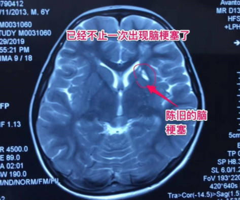 中老年多發(fā)腦梗，6歲兒童竟中招！說話不清、肢體無力、活動障礙、頭暈頭痛…要警惕！