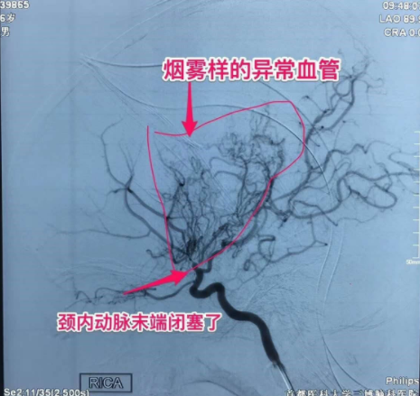 中老年多發(fā)腦梗，6歲兒童竟中招！說話不清、肢體無力、活動障礙、頭暈頭痛…要警惕！