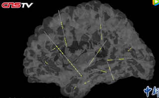 精準(zhǔn)深入大腦深處 創(chuàng)傷小效率高，確定癲癇病灶