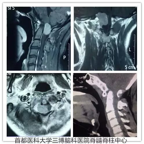 枕大孔區(qū)腦干延髓腹側腦膜瘤