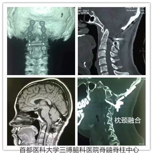 枕大孔區(qū)腦干延髓腹側腦膜瘤