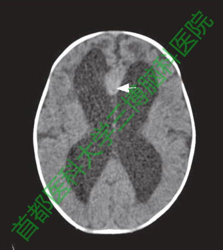 圖1手術(shù)前頭CT。箭頭示縱裂池內(nèi)稍高密度病灶。