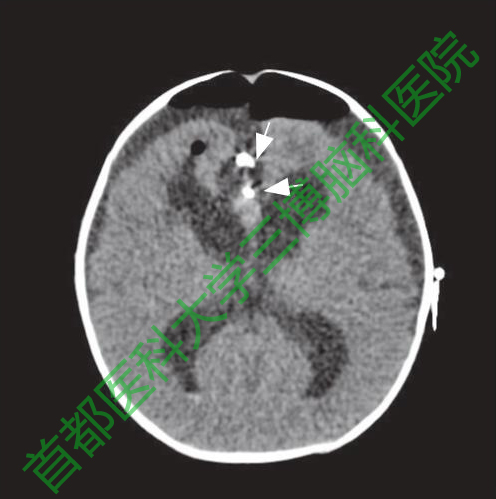 圖5手術(shù)后20小時(shí)頭CT。腦室較手術(shù)前變小。白色箭頭示動(dòng)脈瘤夾。