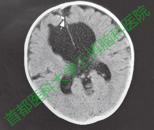 圖6手術(shù)后20個(gè)月復(fù)查頭CT，腦室仍有擴(kuò)張。白色箭頭示動(dòng)脈瘤夾。