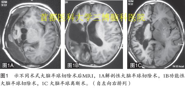 圖1 示不同術(shù)式大腦半球切除術(shù)后MRI，1A解剖性大腦半球切除術(shù)，1B功能性 大腦半球切除術(shù)，1C 大腦半球離斷術(shù)。（自左向右排列）