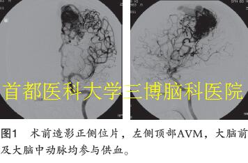 圖1 術(shù)前造影正側(cè)位片，左側(cè)頂部AVM，大腦前 及大腦中動(dòng)脈均參與供血