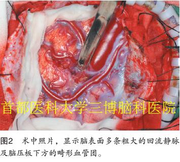 圖2 術(shù)中照片，顯示腦表面多條粗大的回流靜脈 及腦壓板下方的畸形血管團(tuán)