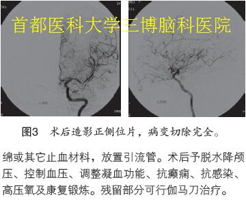 圖3 術(shù)后造影正側(cè)位片，病變切除完全