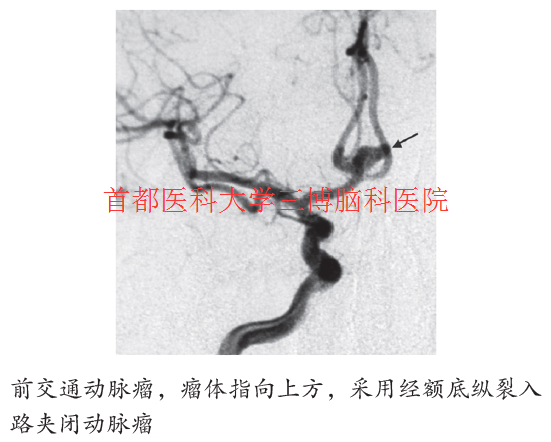 前交通動(dòng)脈瘤，瘤體指向上方，采用經(jīng)額底縱裂入 路夾閉動(dòng)脈瘤