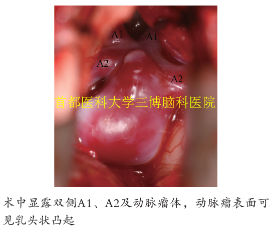 術(shù)中顯露雙側(cè)A1、A2及動(dòng)脈瘤體，動(dòng)脈瘤表面可 見(jiàn)乳頭狀凸起