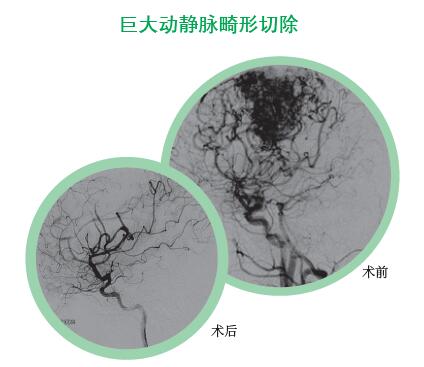 巨大動(dòng)靜脈畸形切除