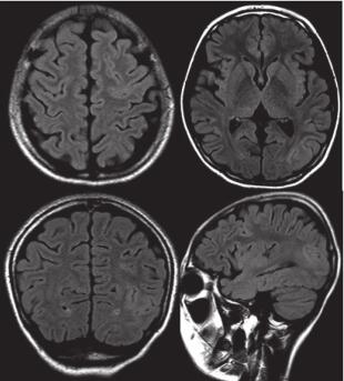 圖 2. 患者頭顱 MRI：左頂枕及左額葉皮層異常信號(hào)。