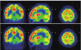 圖 3. 患者 PET：左側(cè)枕葉、顳、頂葉放射性攝取較對(duì) 側(cè)明顯減低。