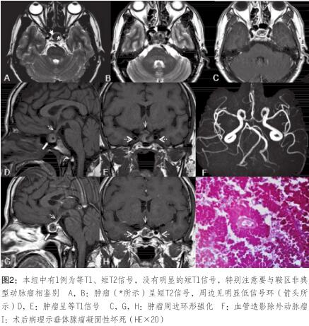 與鞍區(qū)非典 型動(dòng)脈瘤相鑒別