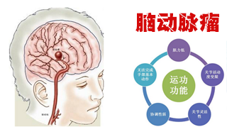 為什么會得腦動脈瘤？腦動脈瘤常見病因