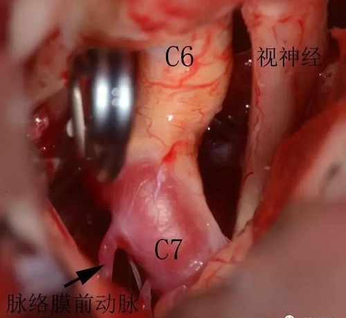 一枚動(dòng)脈瘤夾夾閉動(dòng)脈瘤瘤頸之后，動(dòng)脈瘤消失