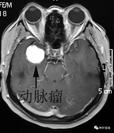 巨大血栓性動脈瘤