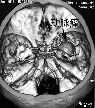 右顳部巨大動脈瘤