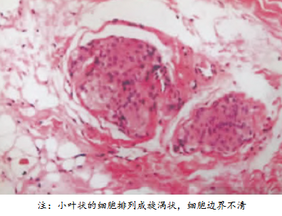 顱內(nèi)外溝通性腦膜瘤怎么治療好？