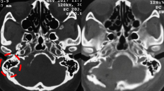 左圖為術(shù)前CT可見頸靜脈孔擴(kuò)大不明顯，舌下神經(jīng)管擴(kuò)大，右圖為術(shù)后CT可見巖骨磨除范圍。