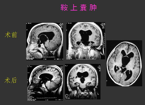 鞍上囊腫病例