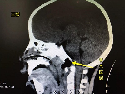 童童術后影像