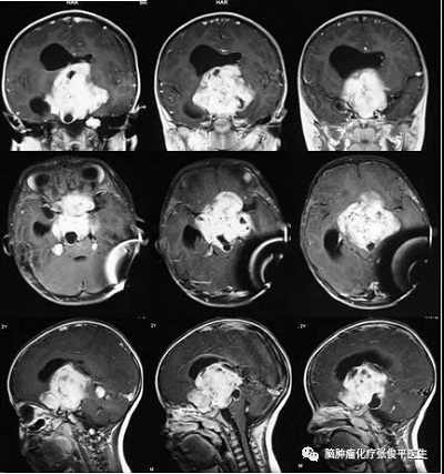 腫瘤由鞍區(qū)突入三腦室內(nèi)，并伴有后顱窩多處轉(zhuǎn)移