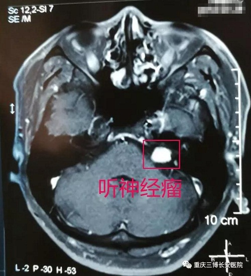 MRI：標(biāo)注處為腫瘤