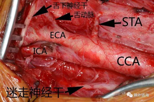 煙霧病術(shù)中照片，顯示相關(guān)結(jié)構(gòu)