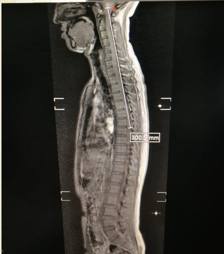 患者脊髓內腫瘤長達300.5mm