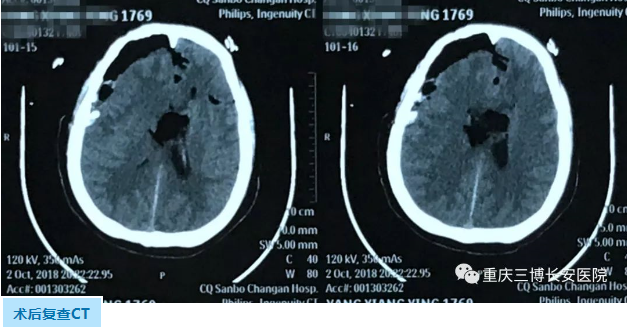 術(shù)后復(fù)查CT