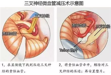 三叉神經(jīng)痛、面肌痙攣……MVD手術(shù)全搞定