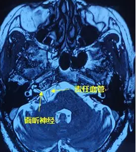 右眼跳”災(zāi)“？小心面肌痙攣！