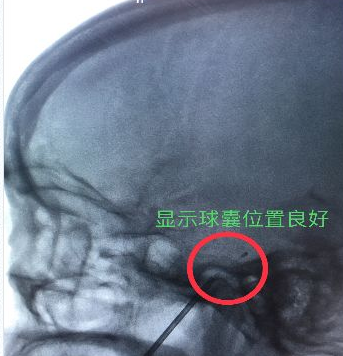 X光下可見黑色顯影導管位置良好