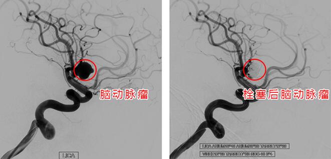 親人去世悲痛欲絕引發(fā)腦動脈瘤破裂 醫(yī)生提醒：高危人群定期做腦部影像檢查