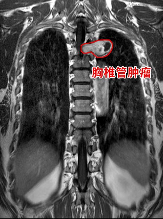 胸疼胸悶竟是胸椎腫瘤在作祟 取出腫瘤整個人都輕松了