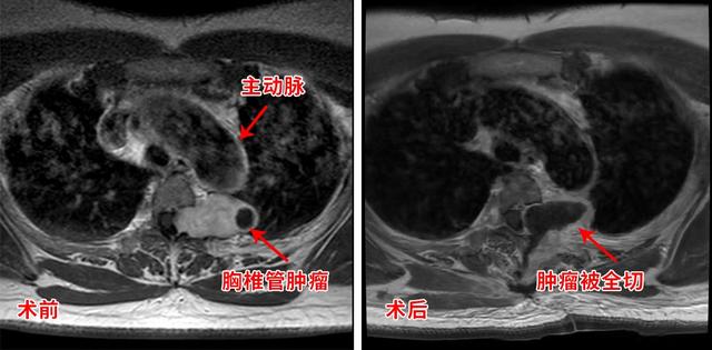 胸疼胸悶竟是胸椎腫瘤在作祟 取出腫瘤整個人都輕松了