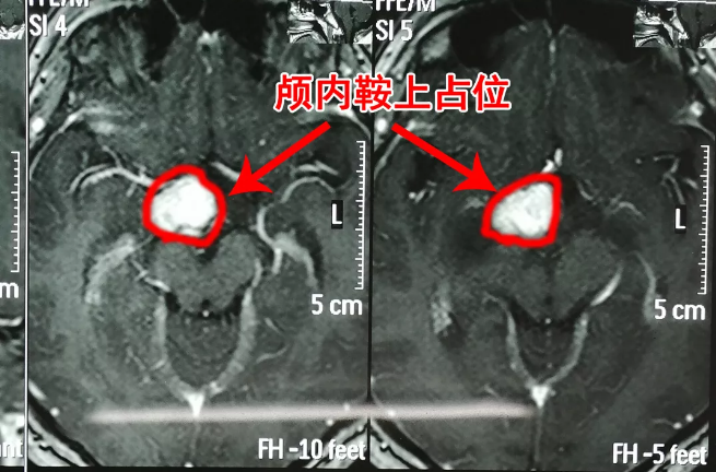 胸部變大的男孩，竟是因為腦中長了腫瘤