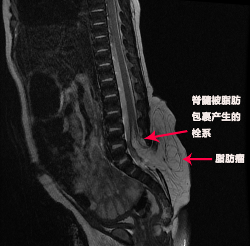 剛出生的寶寶屁股后有鵝蛋大的鼓包 醫(yī)生妙手修補(bǔ)脊柱裂