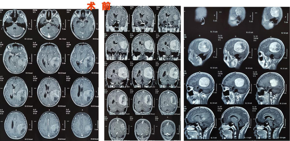 3歲有斗雞眼，父母忽視，13歲發(fā)現(xiàn)巨大腦腫瘤，這些癥狀需警惕!