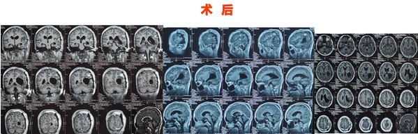 3歲有斗雞眼，父母忽視，13歲發(fā)現(xiàn)巨大腦腫瘤，這些癥狀需警惕!